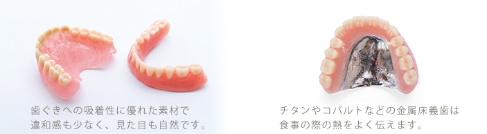 総義歯の種類