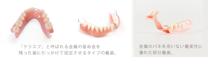 部分義歯の種類